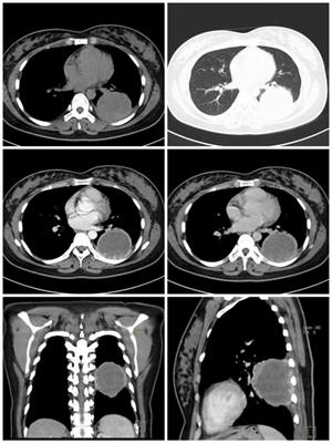 The tumor or inflammation? a case report on primary pulmonary choriocarcinoma